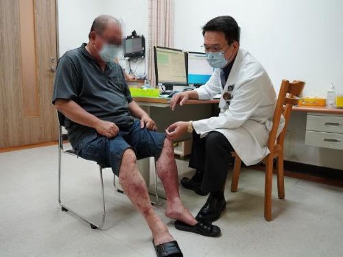 生物製劑安全有效 告別乾癬紅腫癢