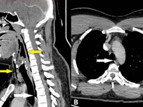 首見全球案例：用手捏住鼻子並閉住嘴，竟導致氣管撕裂